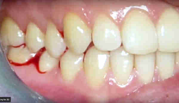 Ziehen zahn kieferknochenentzündung nach MOOCI. Zahn