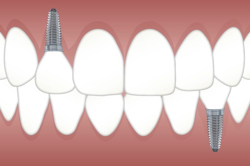 Ziehen zahn kieferknochenentzündung nach Müssen Zähne